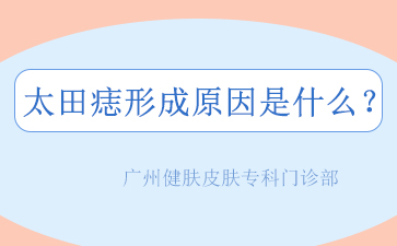 广州胎记医院哪里好，太田痣的形成原因是什么？